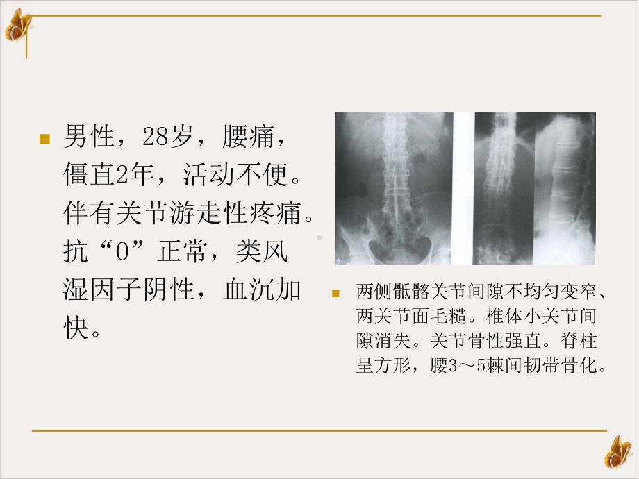 骨关节痹症PPT课件.pptx_第2页