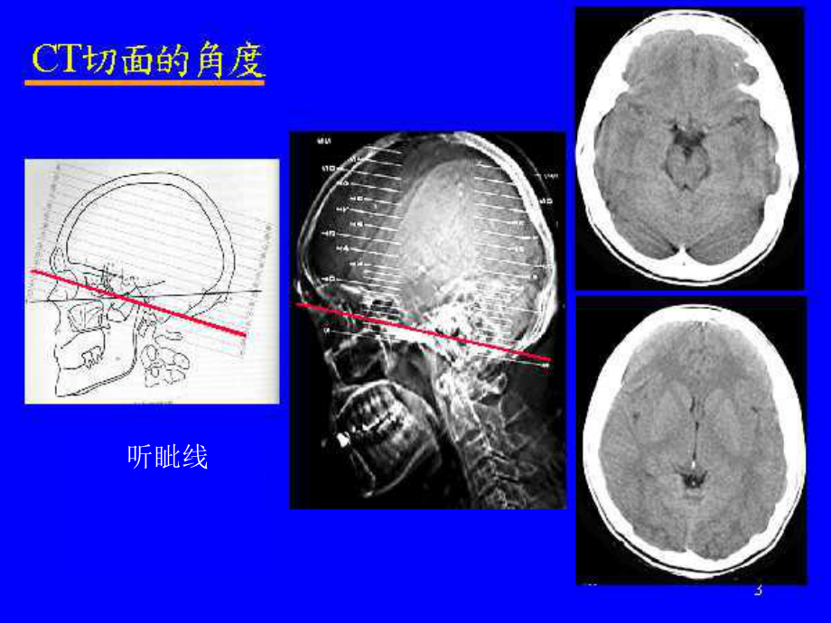 颅脑疾病的CT和MRI诊断课件.pptx_第3页