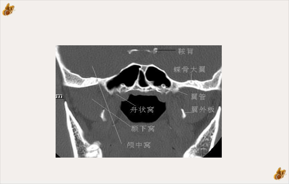 鼻窦病变CT课件.ppt_第3页