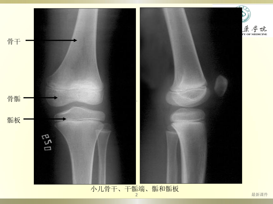 常见骨关节疾病影像专业课件.pptx_第2页