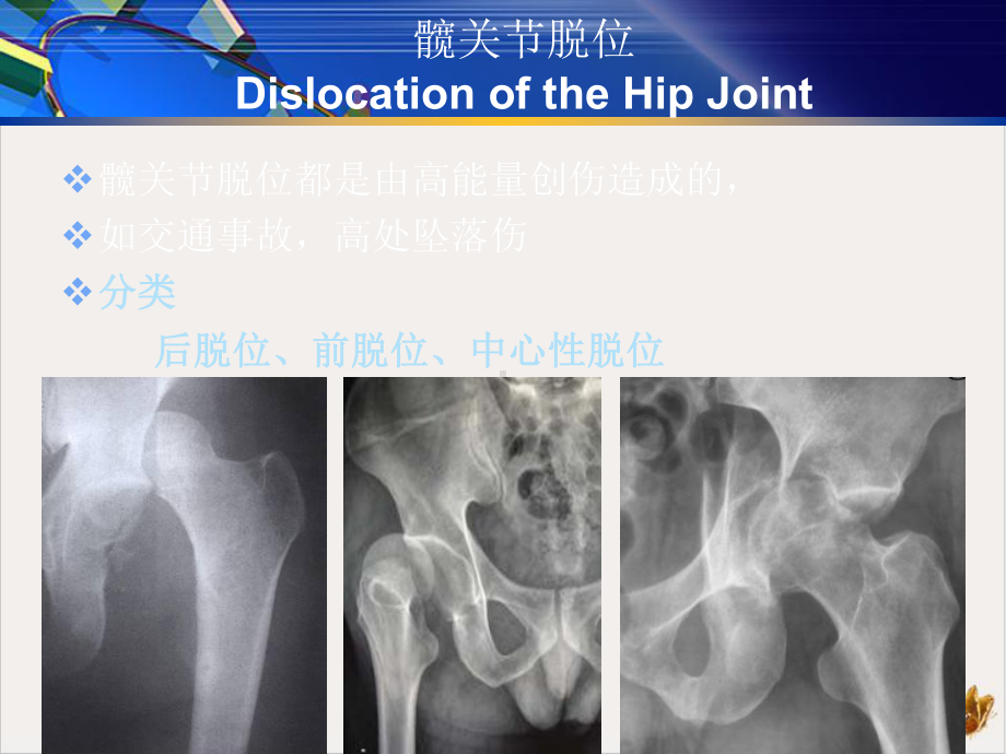 髋关节周围骨折脱位课件.pptx_第2页