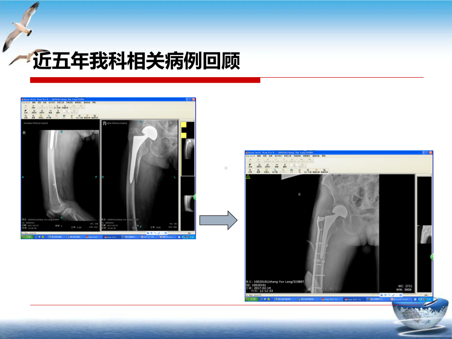 髋关节术后假体周围骨折课件(模板).pptx_第1页