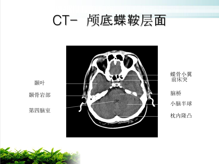 颅脑断层解剖课件(同名207).ppt_第2页