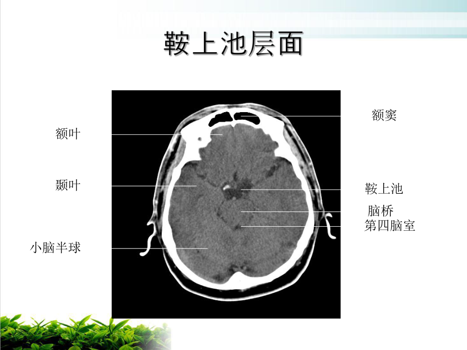 颅脑断层解剖课件(同名207).ppt_第3页