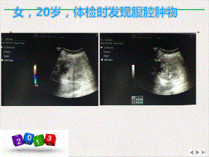 超声科腹组疑难病例讨论课件.pptx