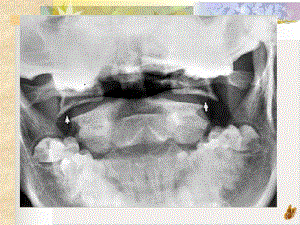颈椎骨折的诊断课件.pptx