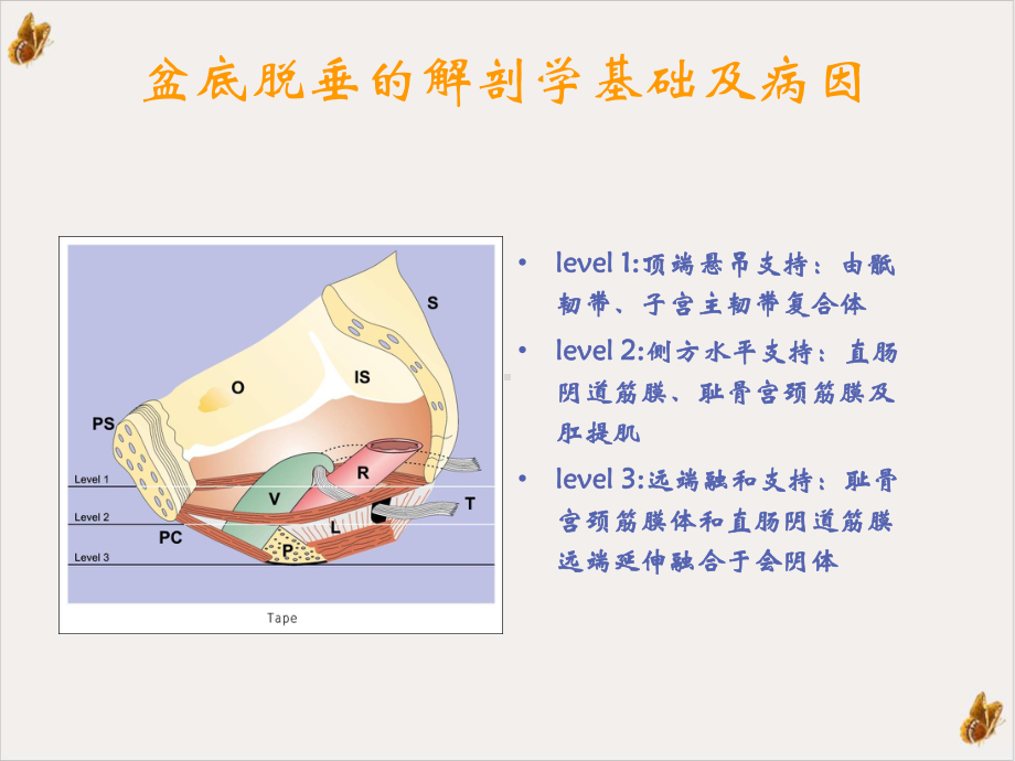 骶棘韧带固定术治疗子宫脱垂实用课件.pptx_第3页