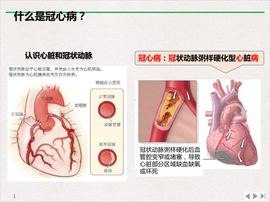 防治高血压冠心病保护好您身体的发动机患教v课件.pptx_第2页