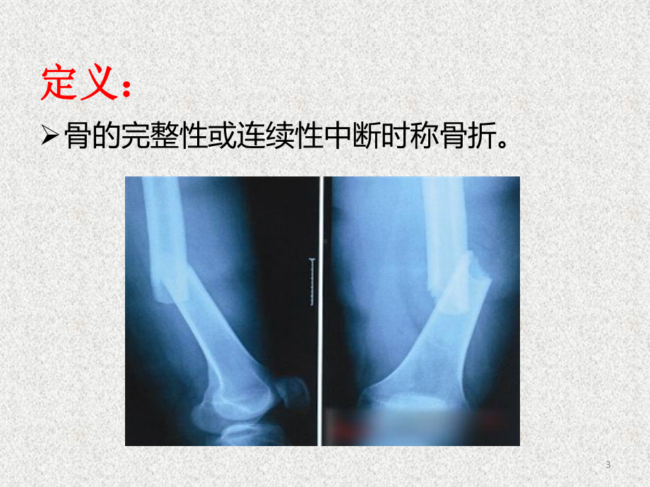 骨与关节损伤课件.ppt_第3页