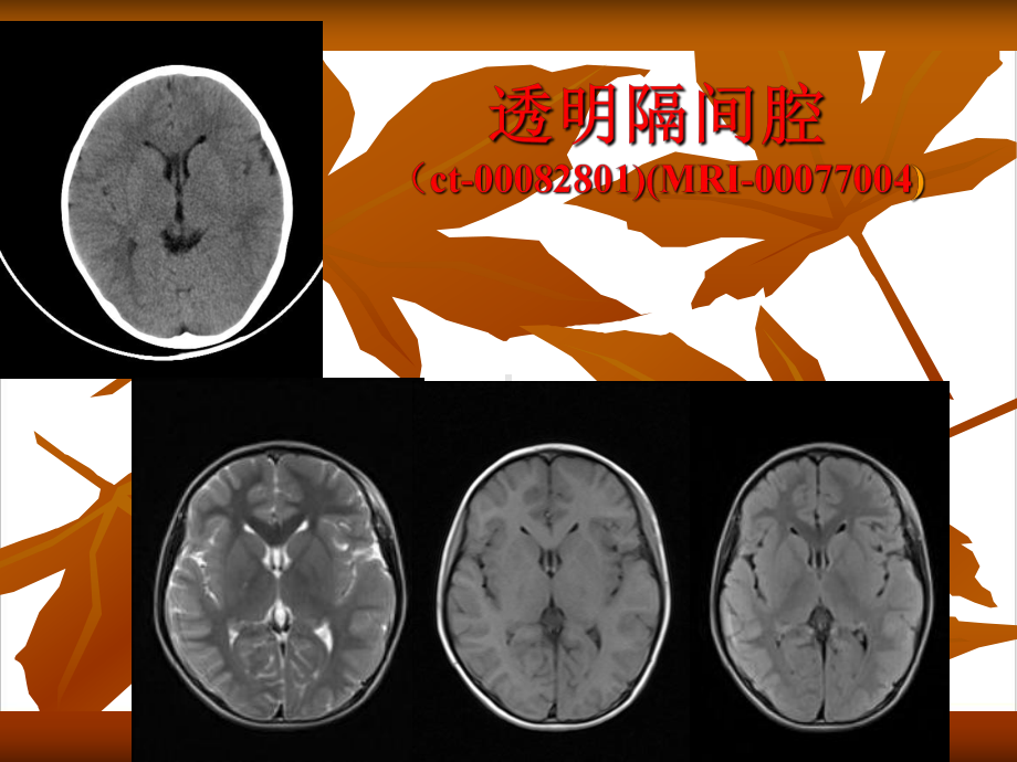 颅脑先天性畸形影象学征象及诊断课件.pptx_第2页