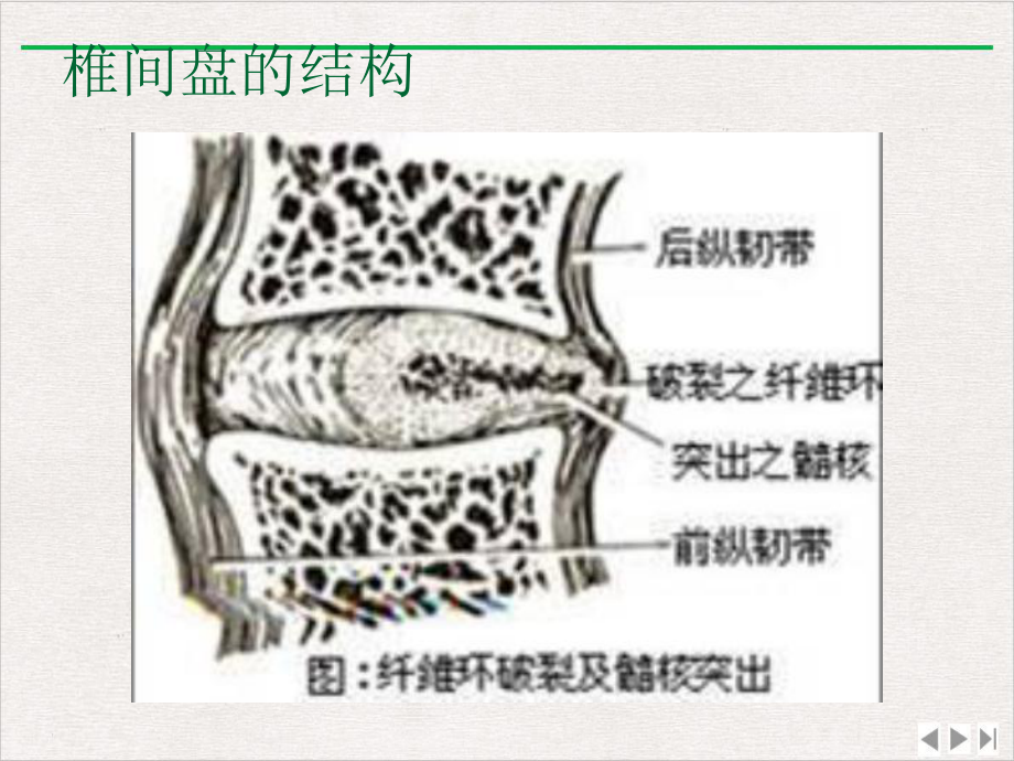 颈腰痛腰间盘突出的防治优选课件.pptx_第3页