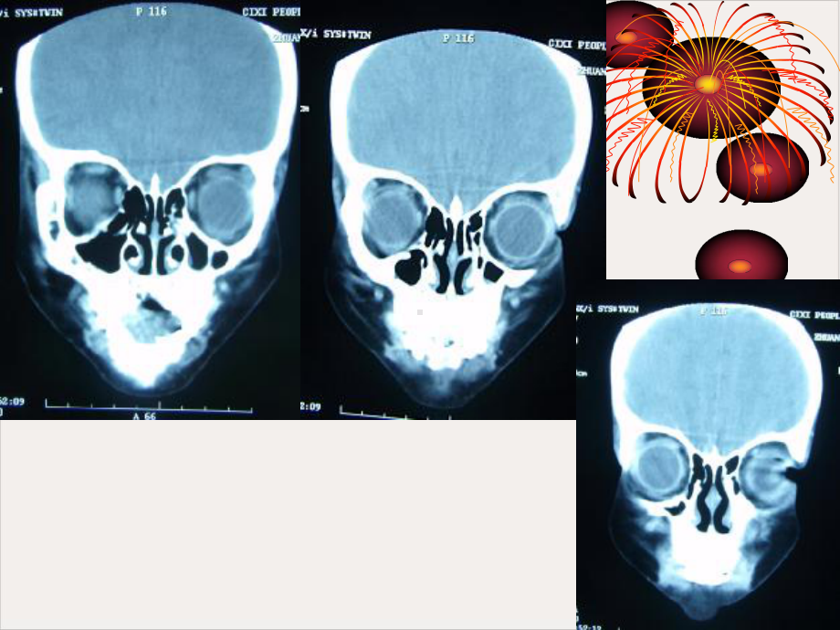 颅骨嗜酸性肉芽肿课件.pptx_第2页