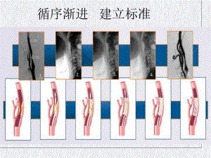 颈动脉支架手术步课件整理.pptx