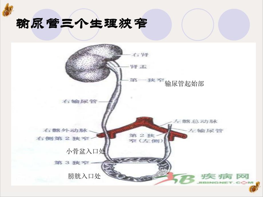 输尿管钬激光碎石护理课件.pptx_第3页