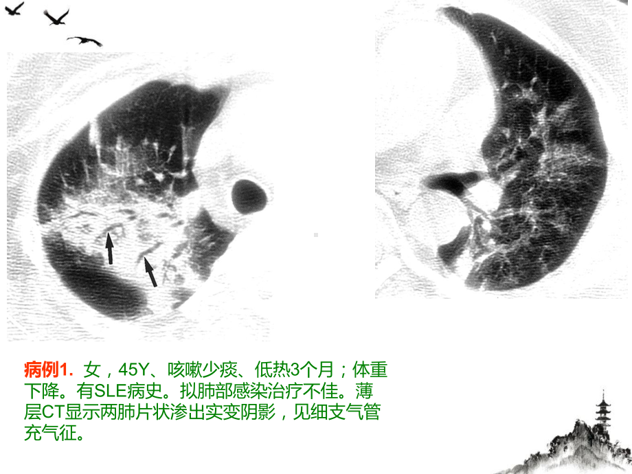 隐源性机化性肺炎的诊断进展课件.pptx_第1页