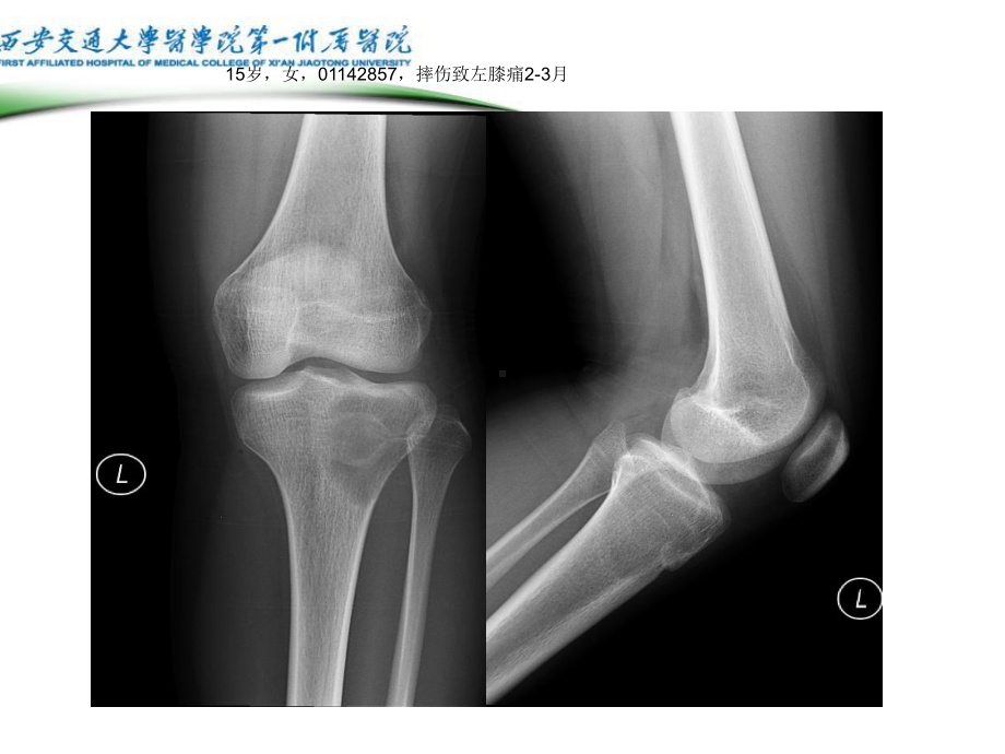 软骨母细胞瘤的影像诊断课件.ppt_第1页