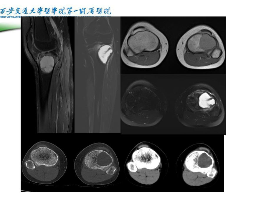 软骨母细胞瘤的影像诊断课件.ppt_第2页