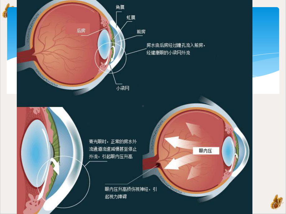 青光眼病例分析培训课件.pptx_第2页