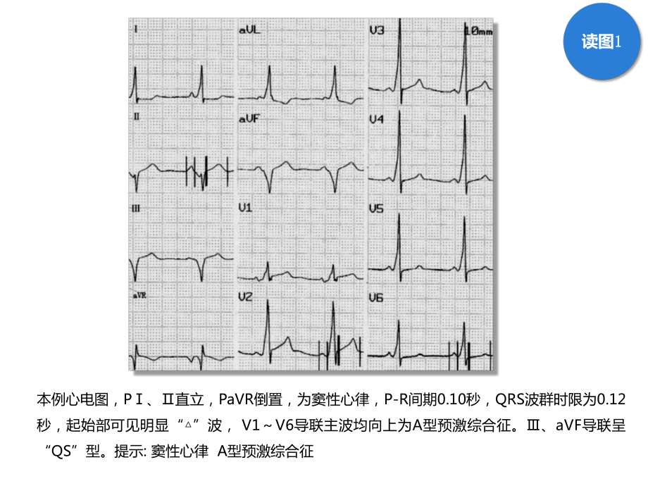 读图识片(预激合并房颤)课件.pptx_第2页