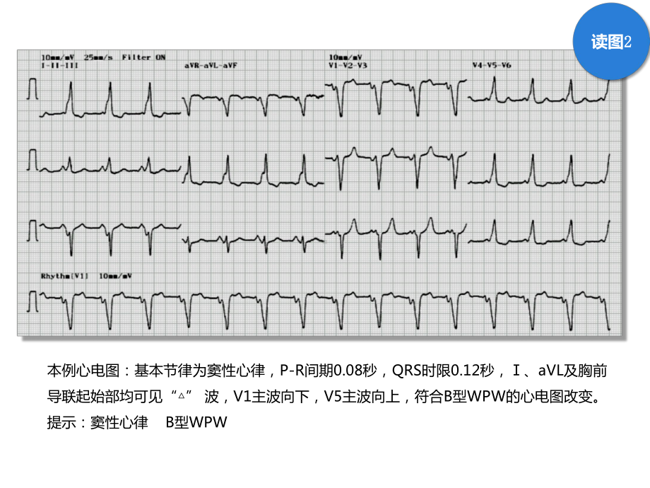 读图识片(预激合并房颤)课件.pptx_第3页