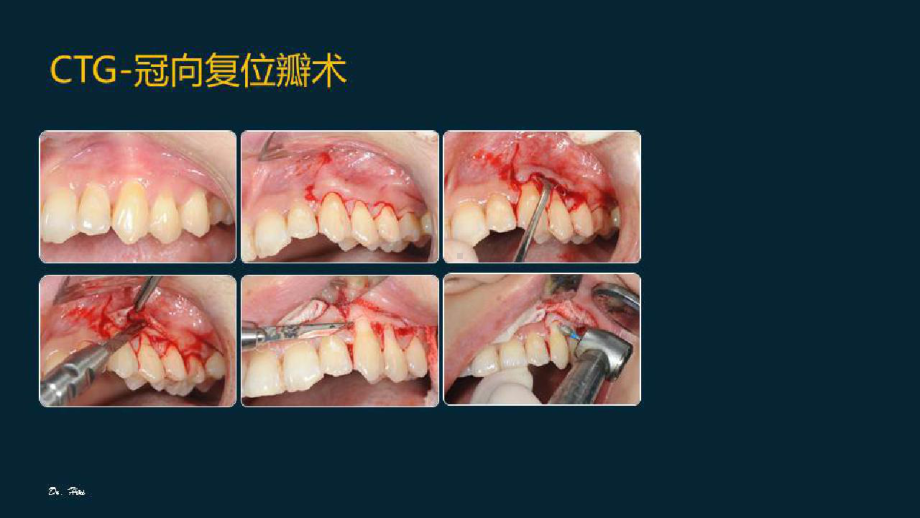 牙周成形术之美学应用及手术要点解析结缔组织瓣移植术的临床应用考量及技巧要点(三)课件.pptx_第2页