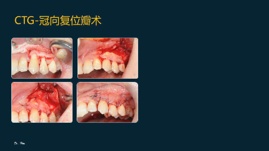 牙周成形术之美学应用及手术要点解析结缔组织瓣移植术的临床应用考量及技巧要点(三)课件.pptx_第3页