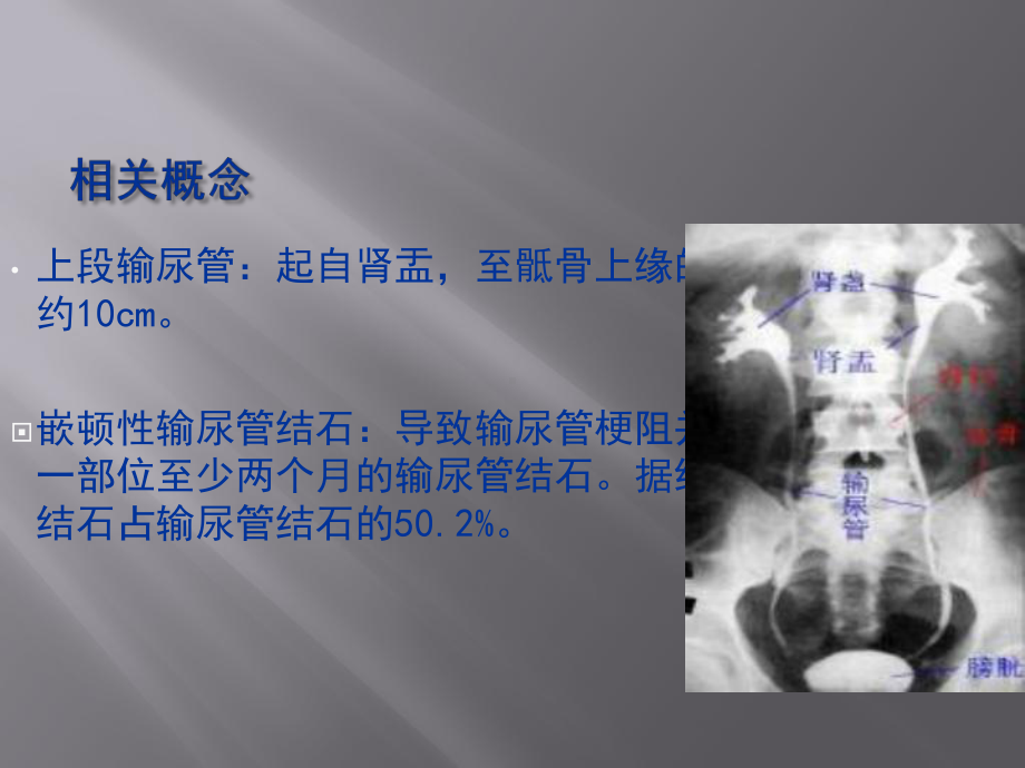 输尿管上段嵌顿性结石微创治疗方法的选择课件.pptx_第2页