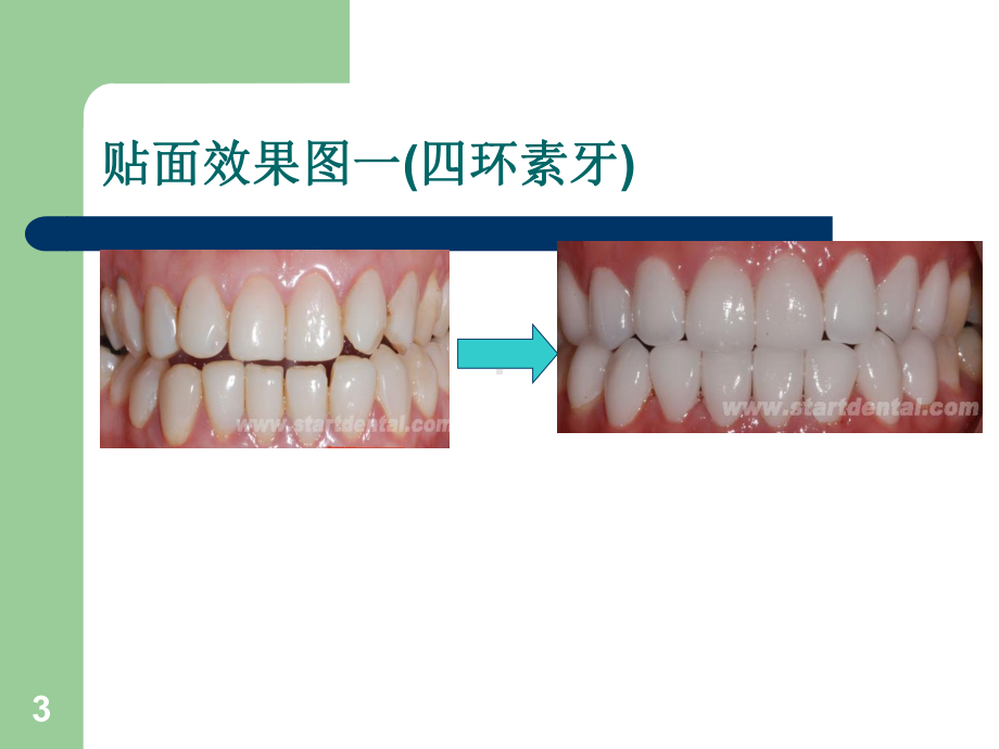 贴面研究教学课件.ppt_第3页