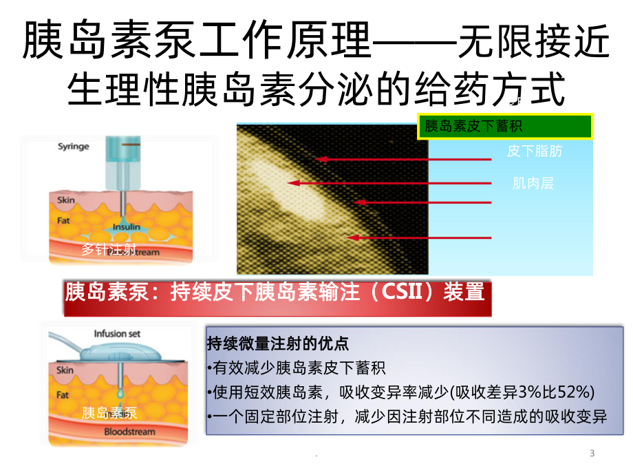 胰岛素泵治疗的护理-课件.ppt_第3页