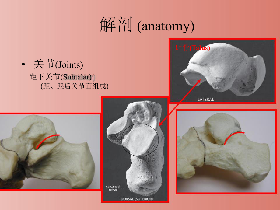 跟骨骨折治疗新进展课件.pptx_第3页