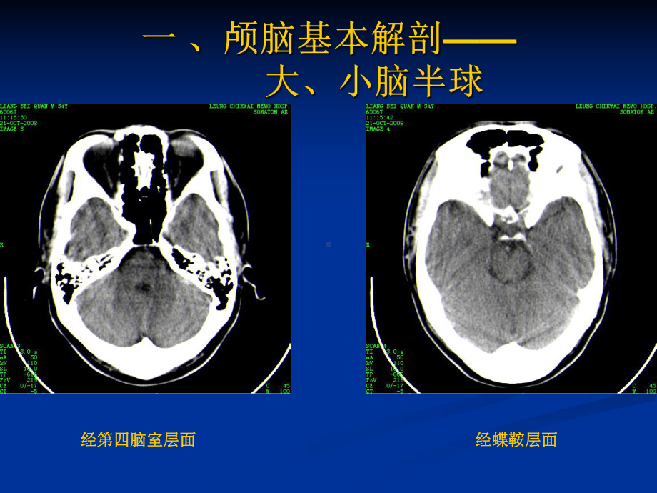 颅脑基本CT征象及颅脑外伤性疾病CT诊断课件.ppt_第2页