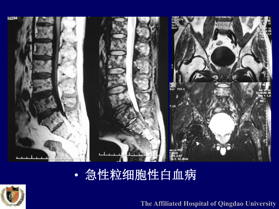 脊椎单发肿瘤-影像诊断与鉴别诊断课件.ppt_第3页