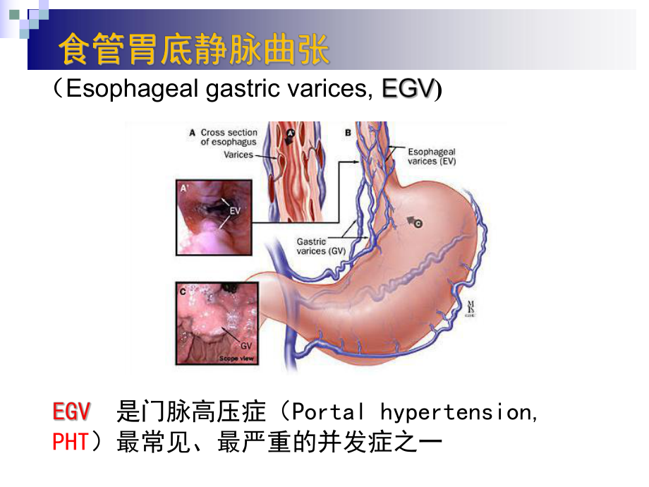 食管胃底静脉曲张出血的内镜诊治指南解读课件.ppt_第3页