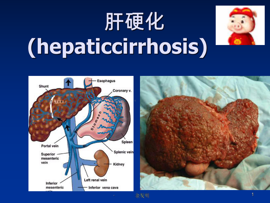 《肝硬化完整》课件.ppt_第1页