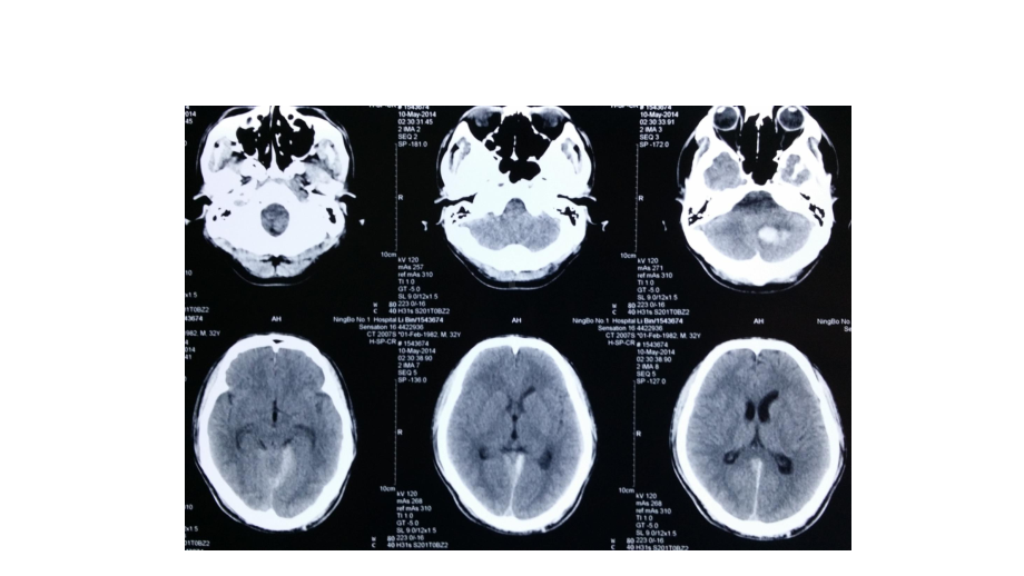 病例分享-颅内感染(脑积水)课件.ppt_第3页