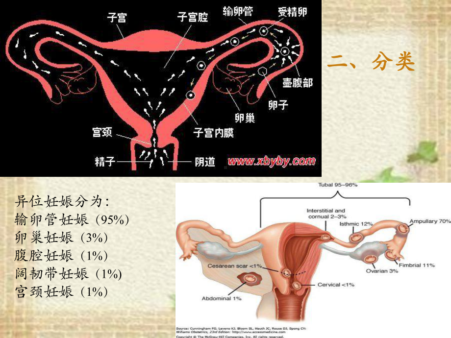 （实用课件）护理查房(宫外孕)课件.ppt_第3页