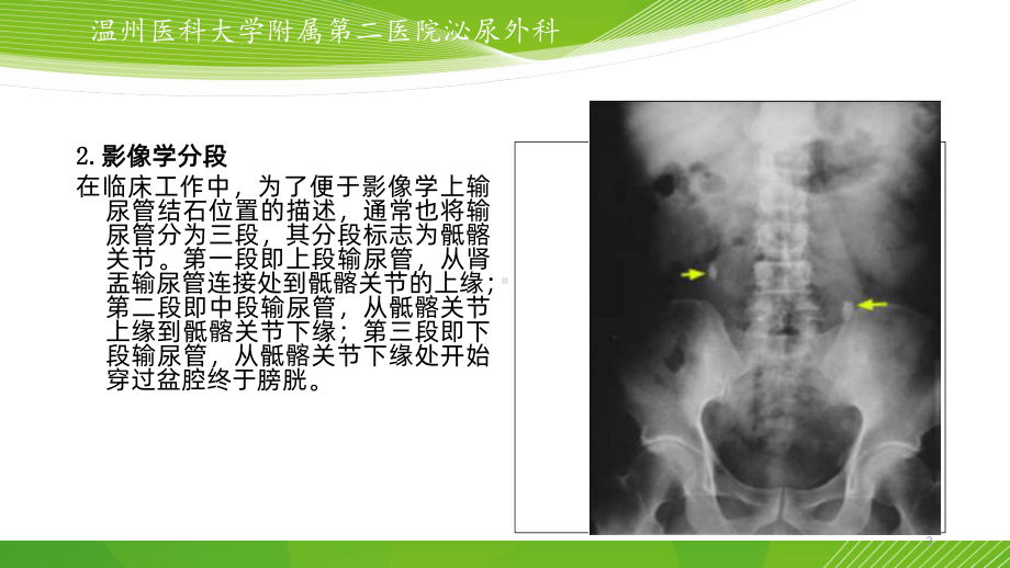 输尿管结石的微创治疗课件.ppt_第3页