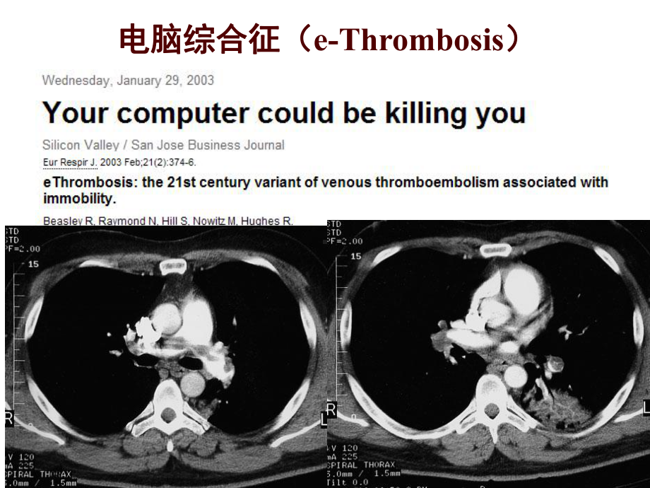 肺血栓栓塞症诊断和治疗-翟振国课件.ppt_第2页