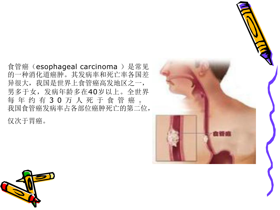 食道癌及术前术后护理课件.ppt_第2页