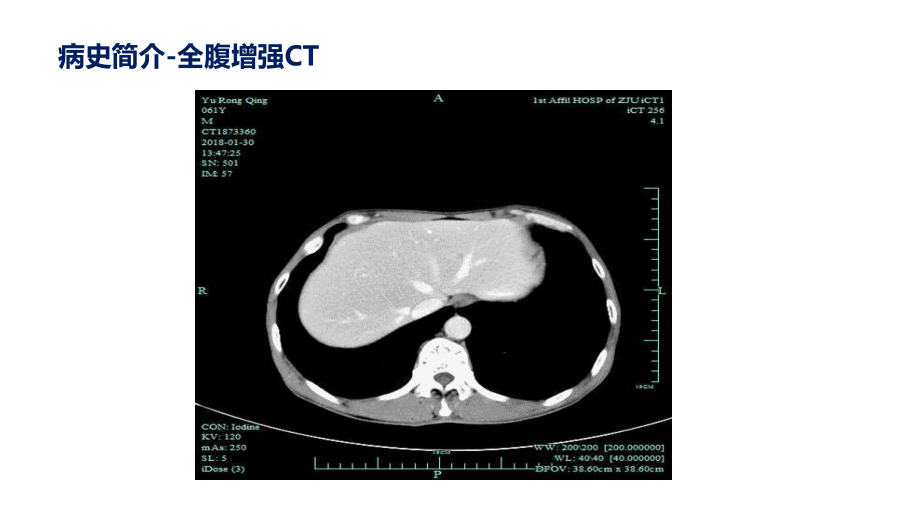 胰腺癌病例-张航瑜课件.pptx_第3页