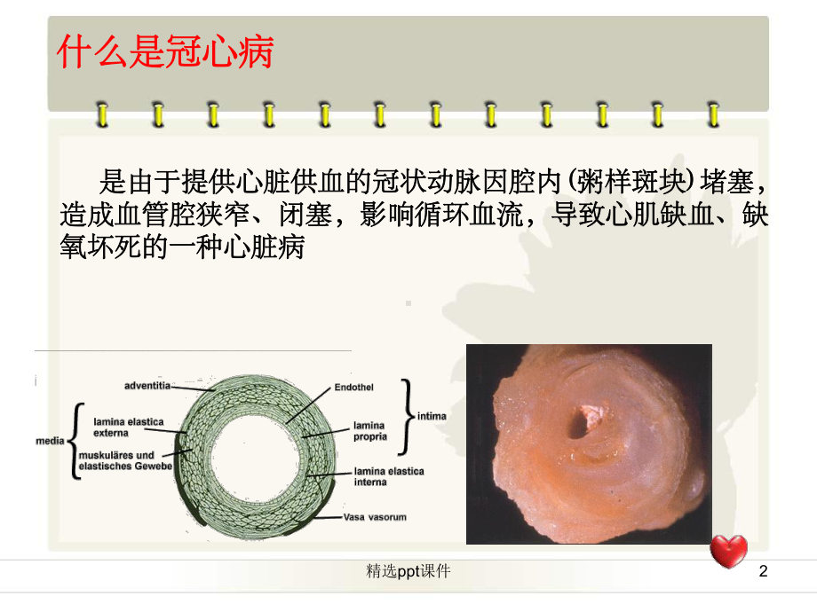 《冠心病的介入治疗》课件.ppt_第2页