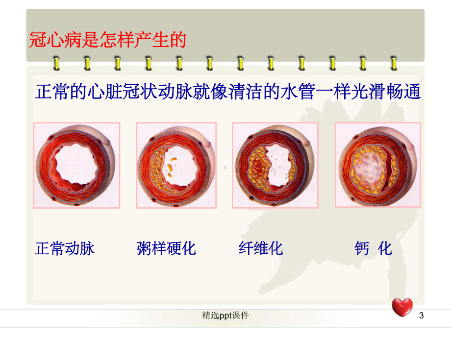 《冠心病的介入治疗》课件.ppt_第3页