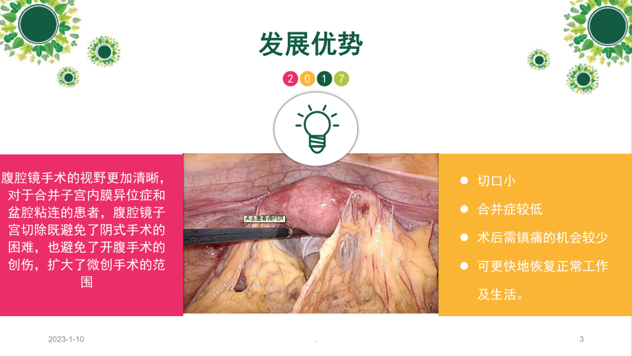 腹腔镜下全宫切-护理查房课件.ppt_第3页