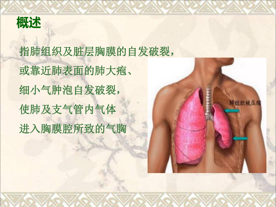 气胸护理查房课件最新版.ppt_第3页