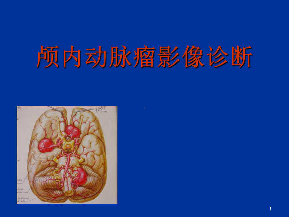 颅内动脉瘤影像诊断课件.ppt_第1页