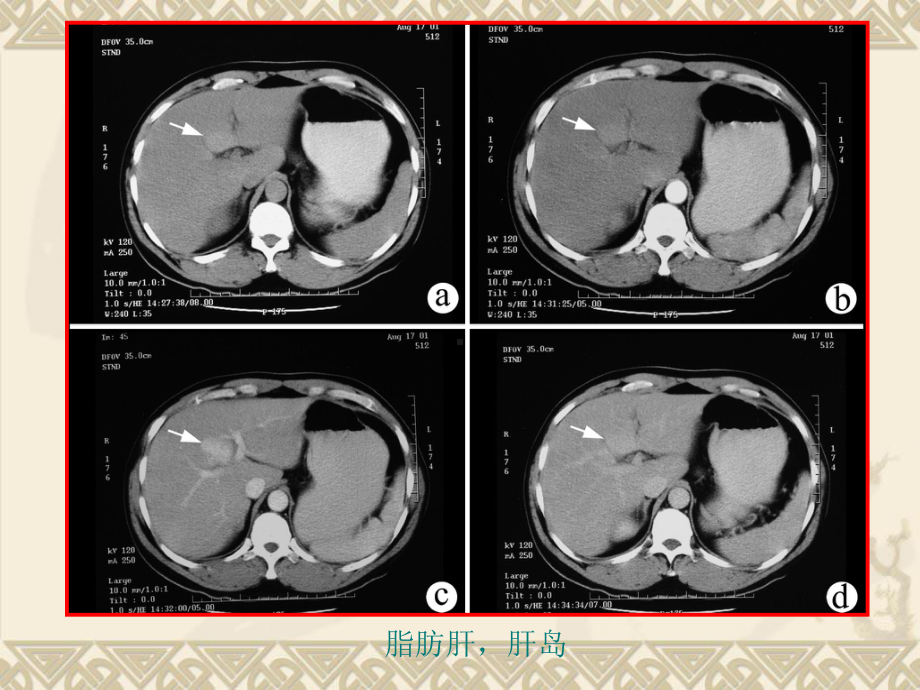 腹部影像诊断5课件.ppt_第3页