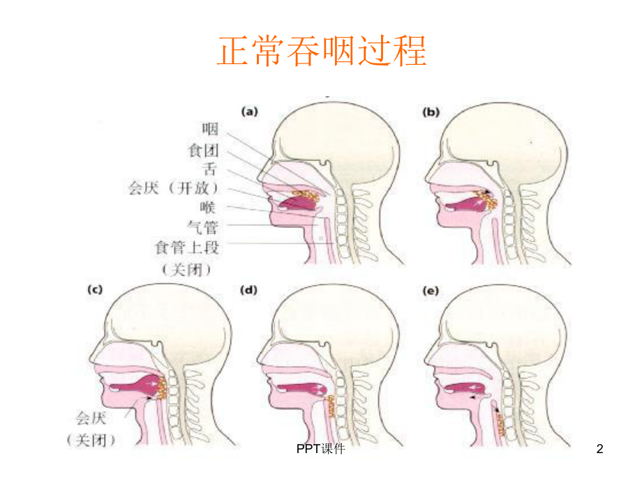 吞咽障碍护理-课件.ppt_第2页