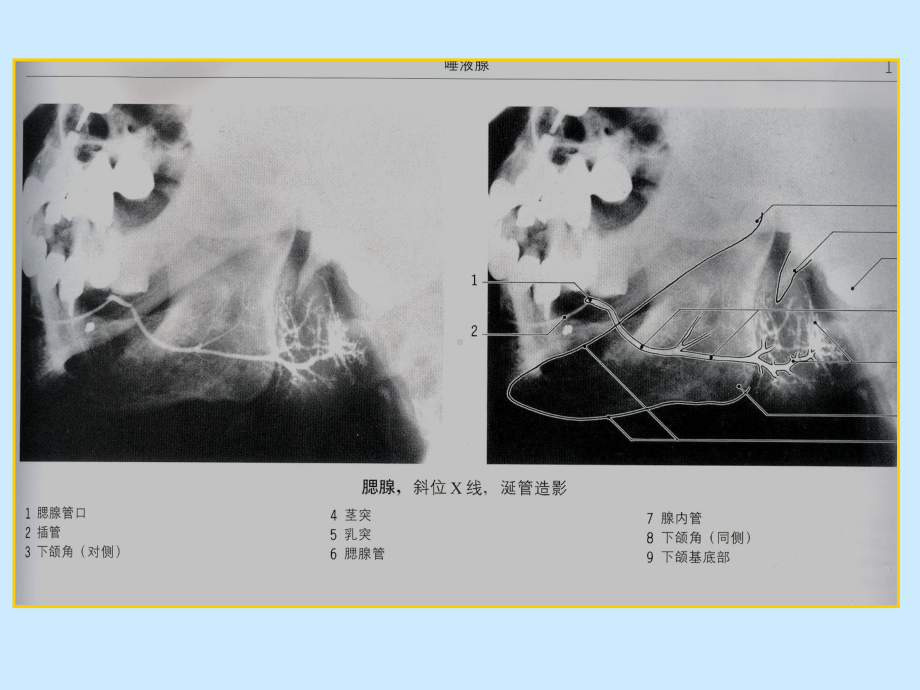 腮腺疾病的影像诊断课件.ppt_第3页