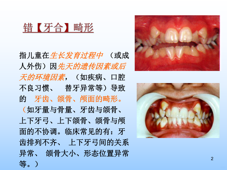 错颌畸形的病因课件.ppt_第2页