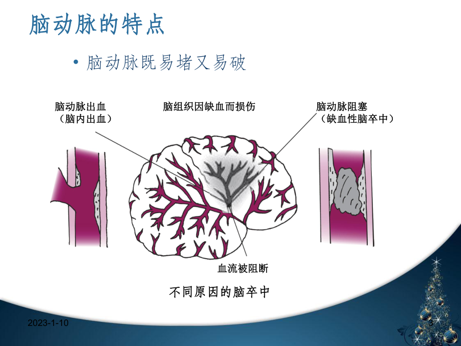 脑卒中科普课件.ppt_第3页